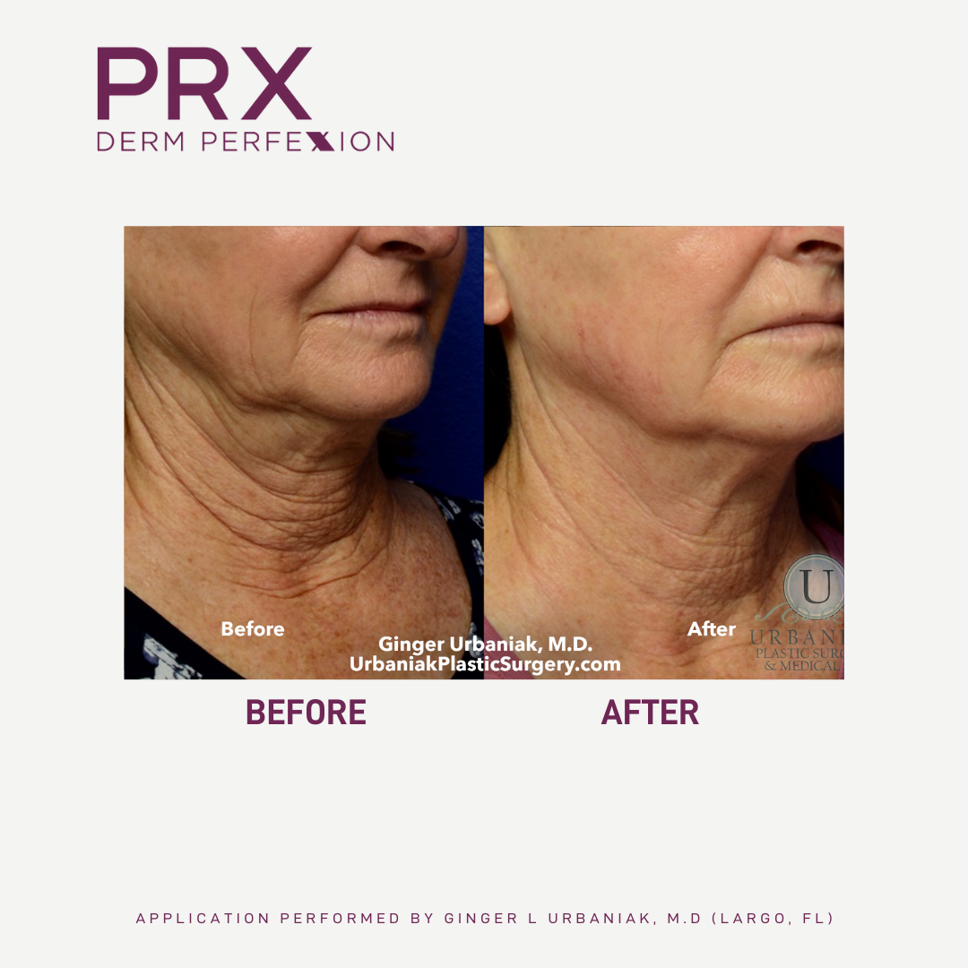 Prx before and after 3