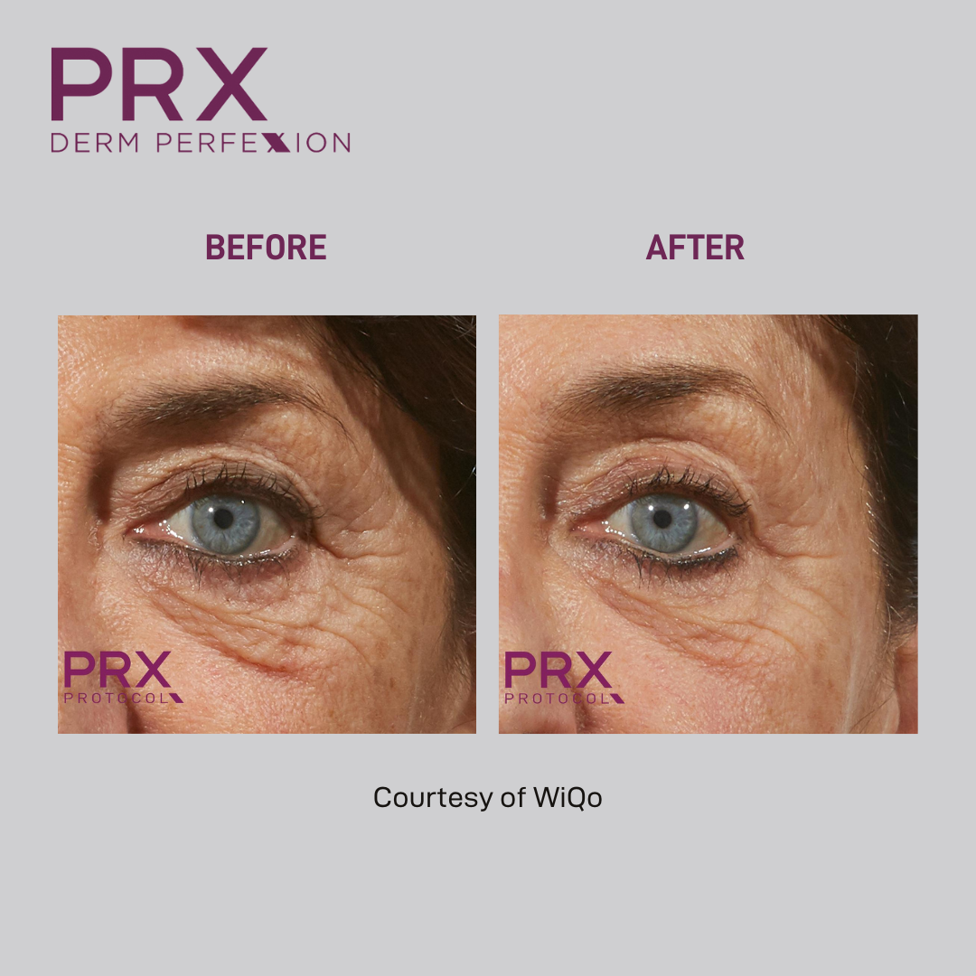 prx before and after 5