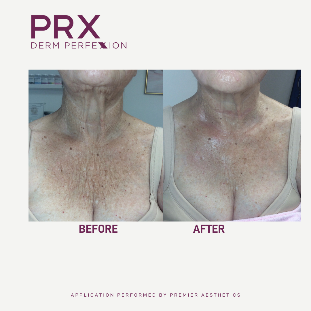 prx before and after 7