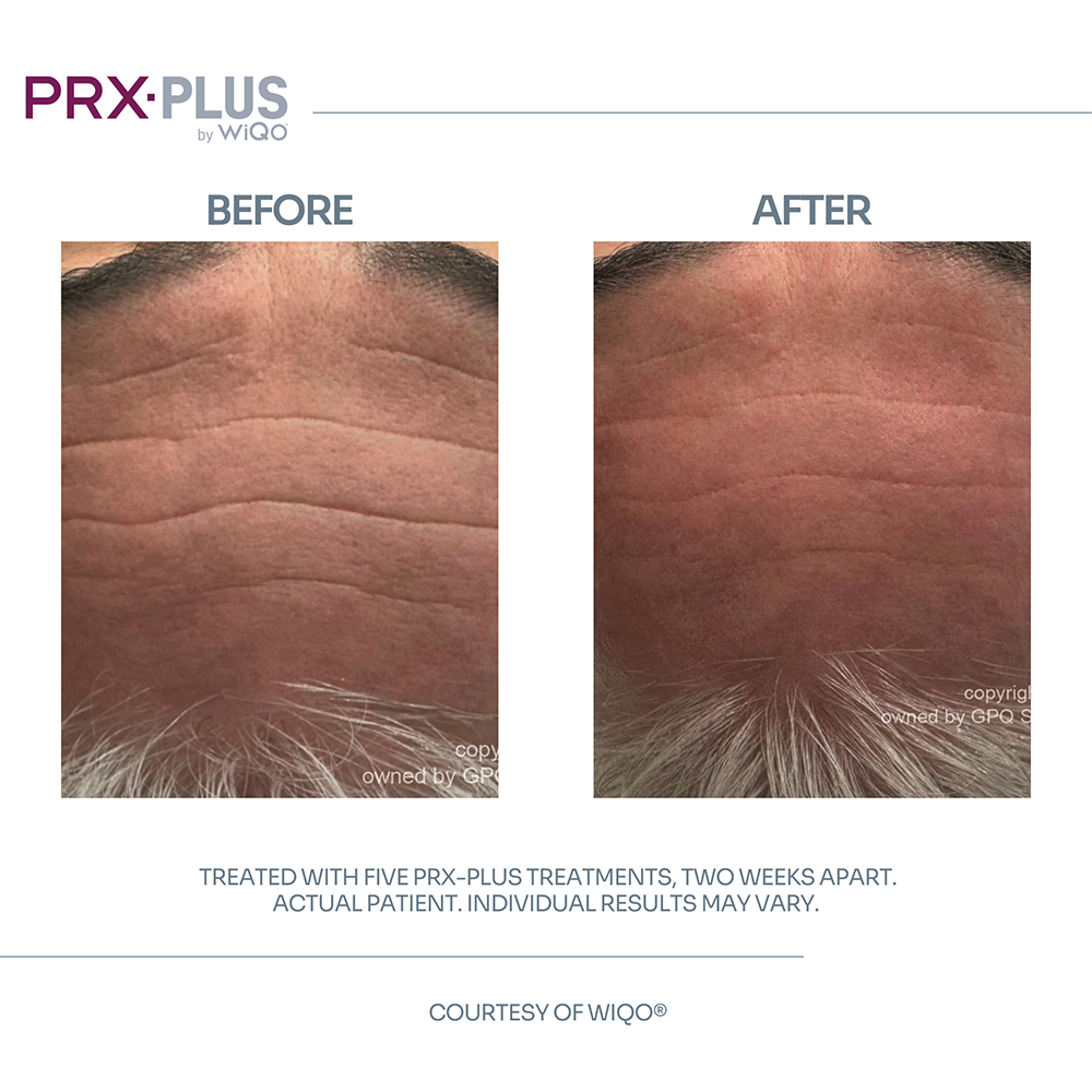 PRX-PLUS Treatments 1