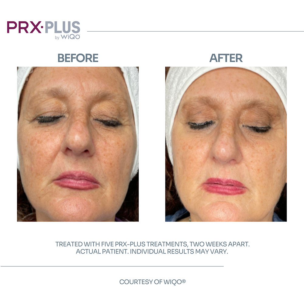 PRX-PLUS Treatments 2