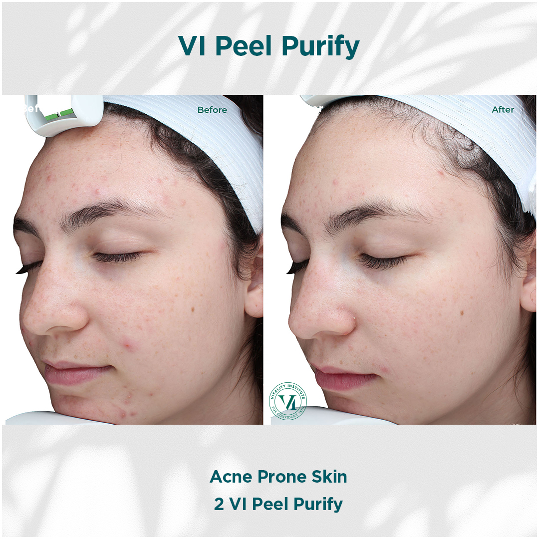 VI Peel Purify