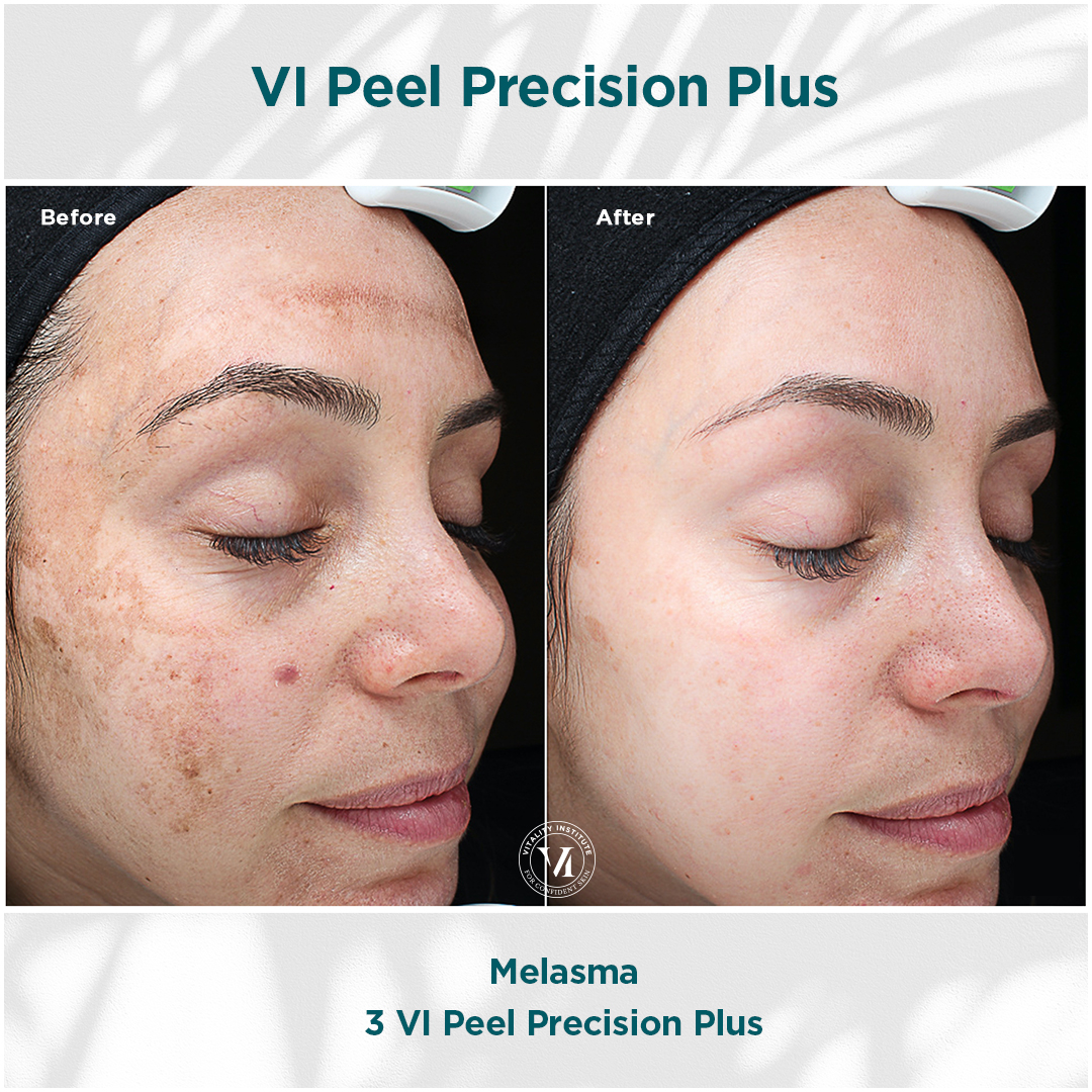 VI Peel precision Plus
