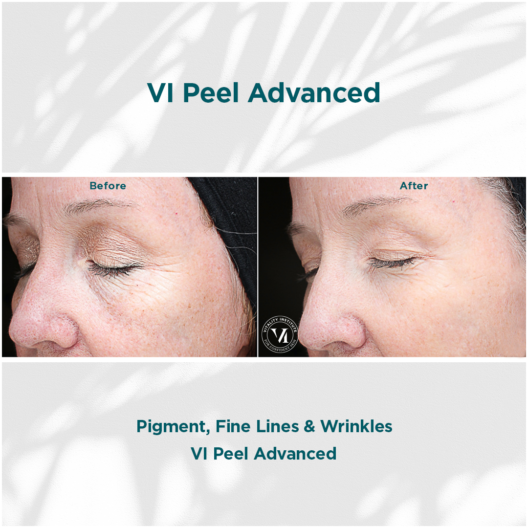 VI peel advanced