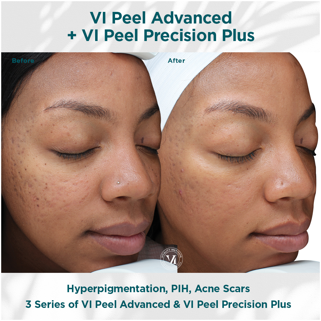Vi Peel Advanced and Precision Plus Combo