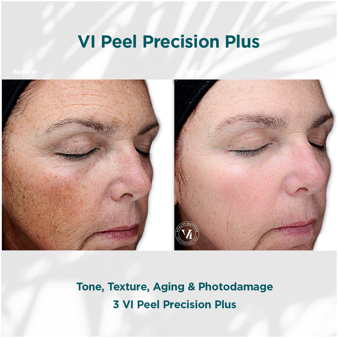 Vi Peel Precision Plus 1